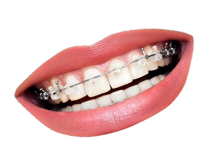 Teeth with Metal Braces Clipart